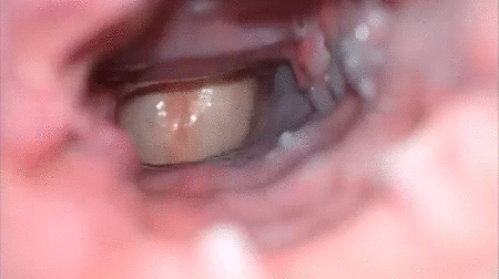 Lady L. reccomend painful tooth extraction